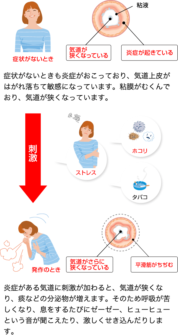 喘息 気管支喘息 ってどんな病気 チェンジ喘息 なるほど ぜんそく Com